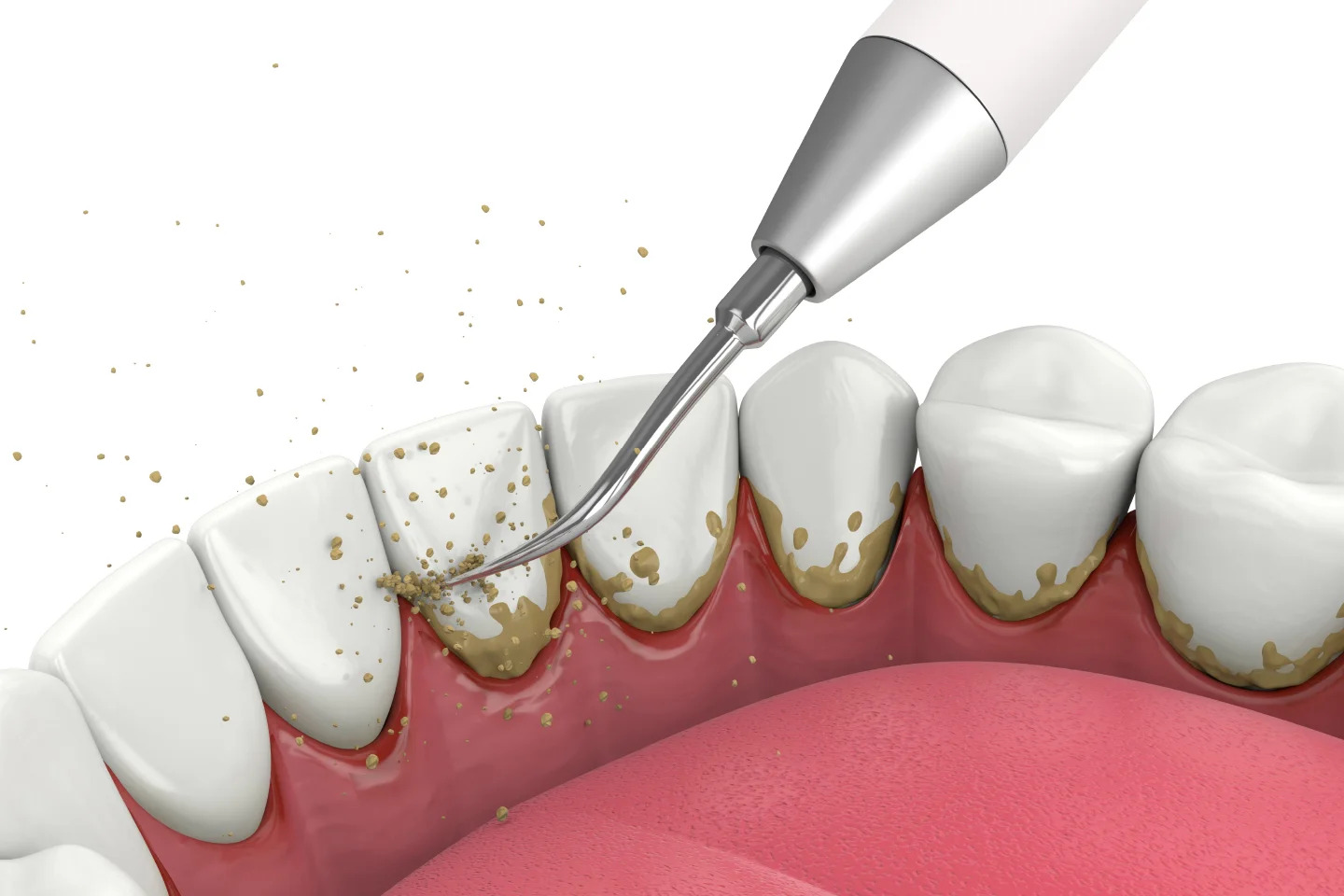 Oral Exam And Teeth Cleaning - Dr. Sunit Jain Dental Care