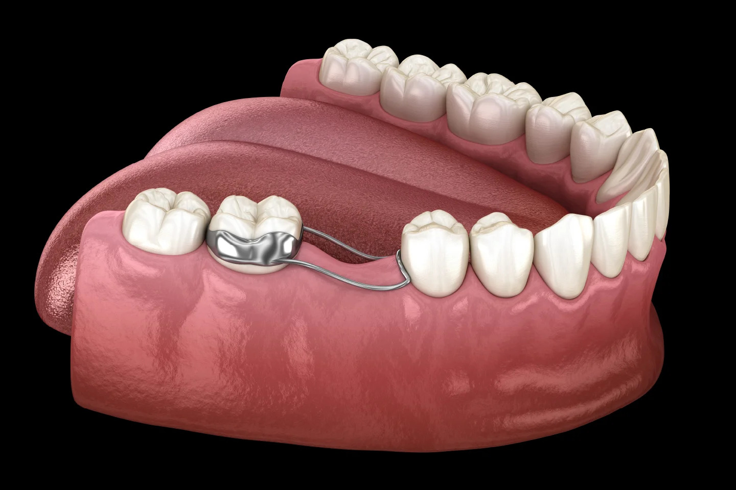Space Maintainer - Dr. Sunit Jain Dental Care