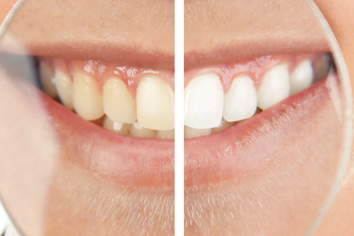 Teeth Whitening - Dr. Sunit Jain Dental Care